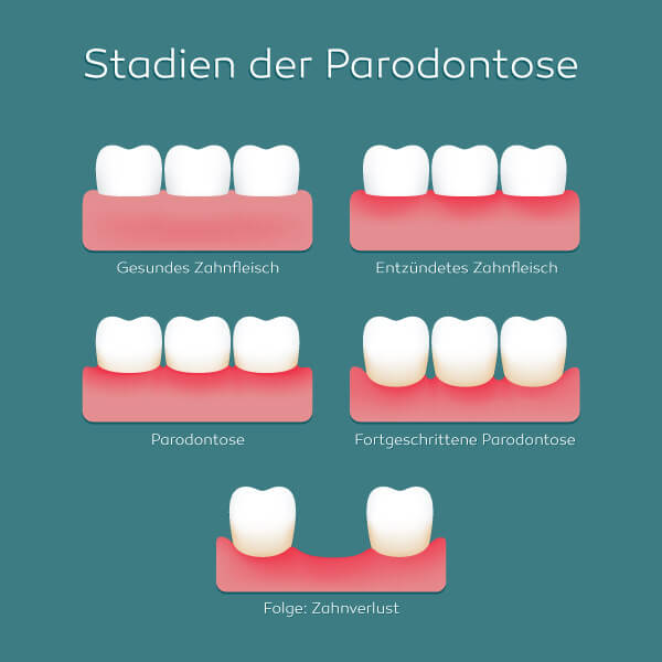 zahnarzt-darmstadt-parodontose